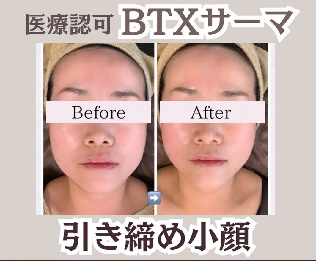 BTXサーマ