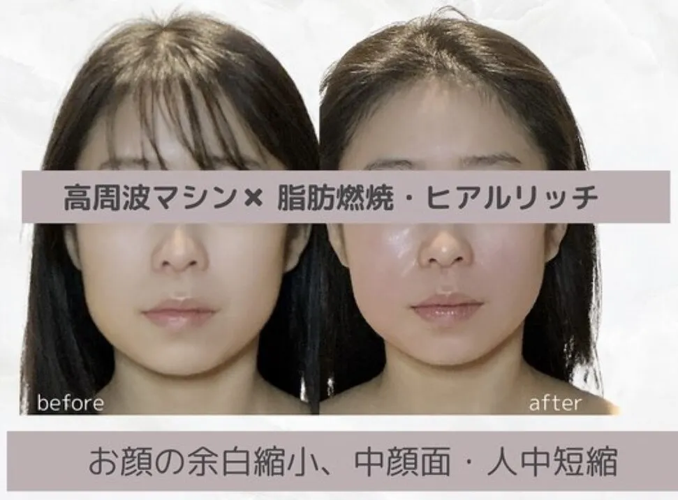高周波マシン×脂肪増減