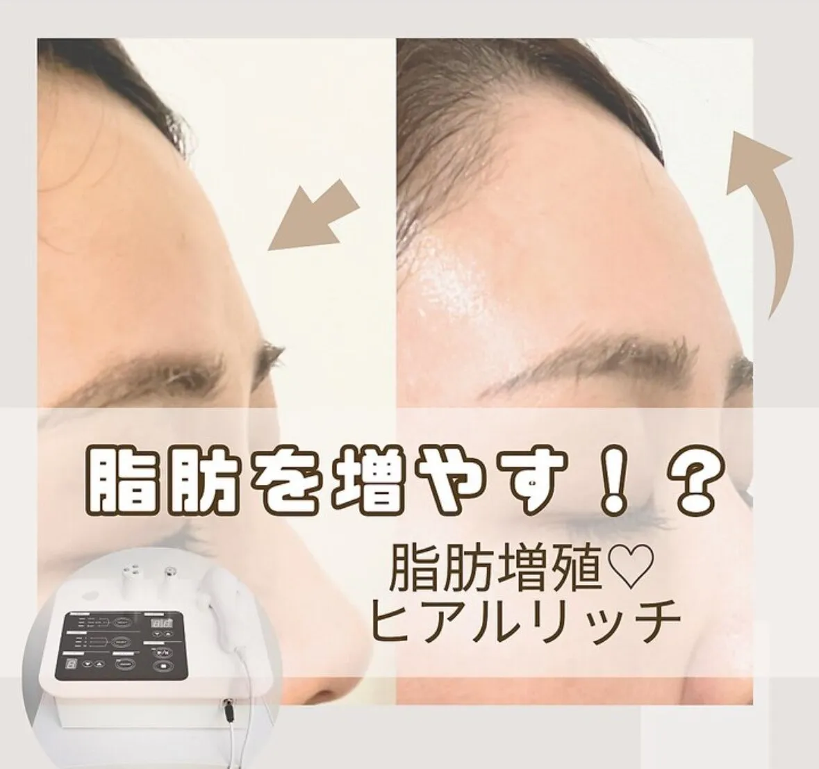 自身の脂肪を増やす