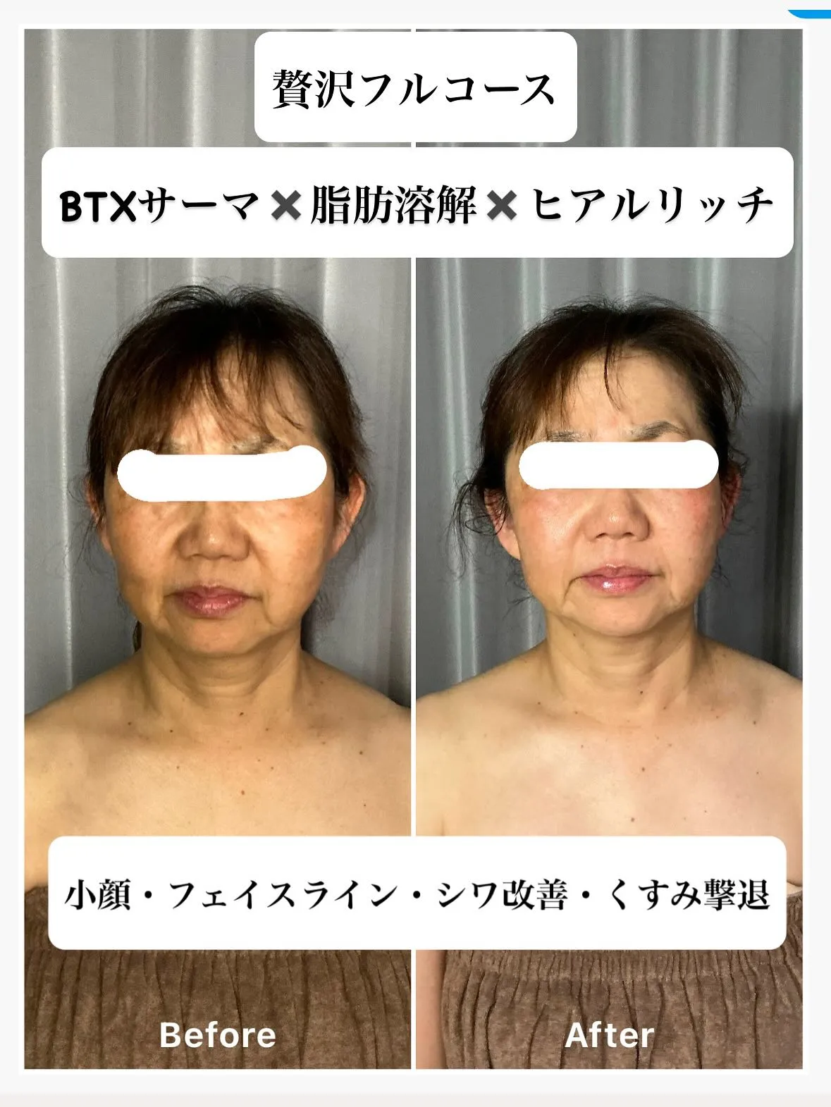 先日、60代女性の方が肌のくすみ、シワ、そしてたるみでお悩み...