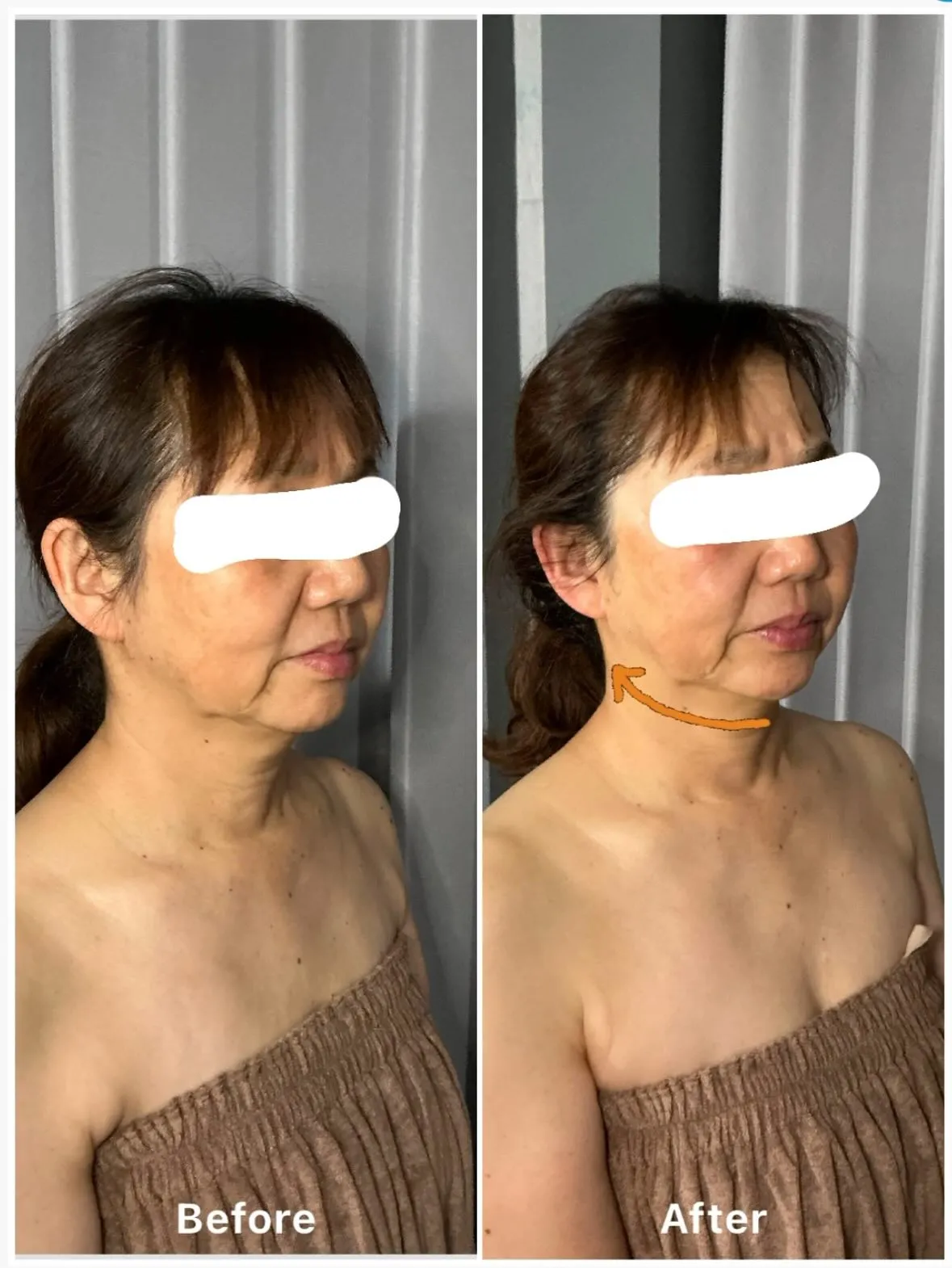 先日、60代女性の方が肌のくすみ、シワ、そしてたるみでお悩み...