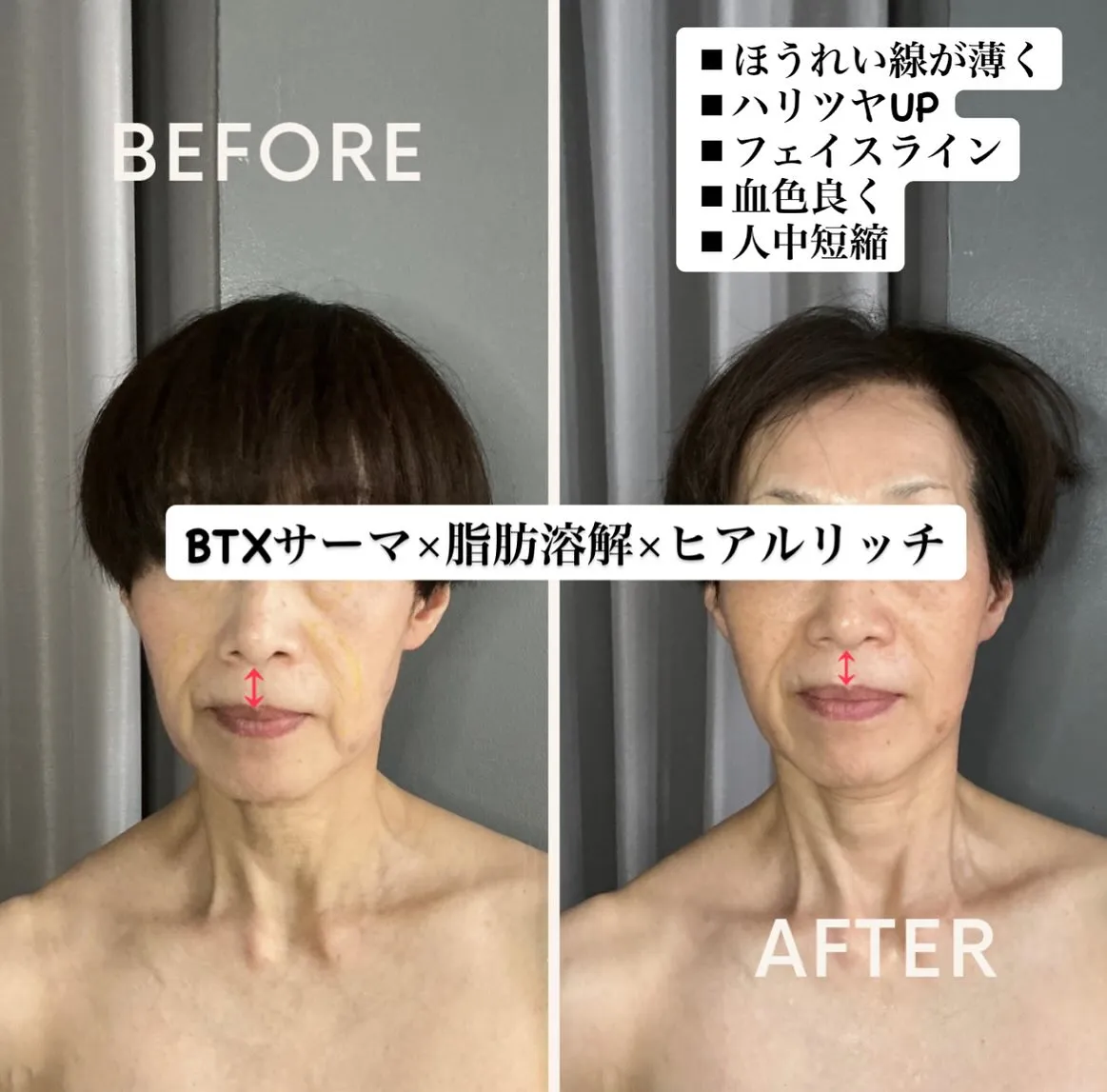 本日は、BTXサーマ、脂肪溶解、そしてヒアルリッチの3つの施...