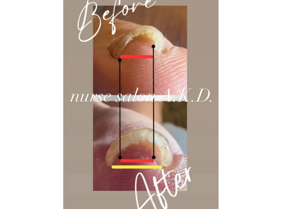 昨年12月に巻き爪講習を受講させて頂きました。