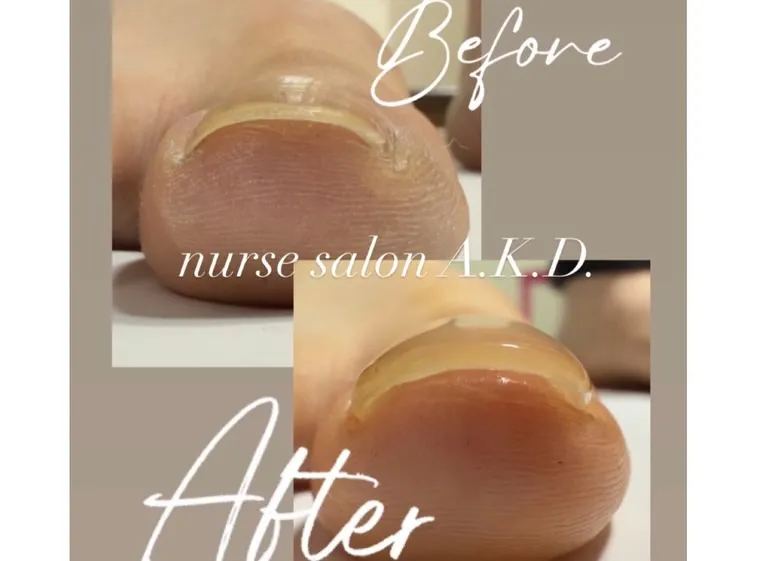 昨年12月に巻き爪講習を受講させて頂きました。